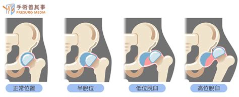 人字形石膏|發展性髖關節發育不良 (DDH)